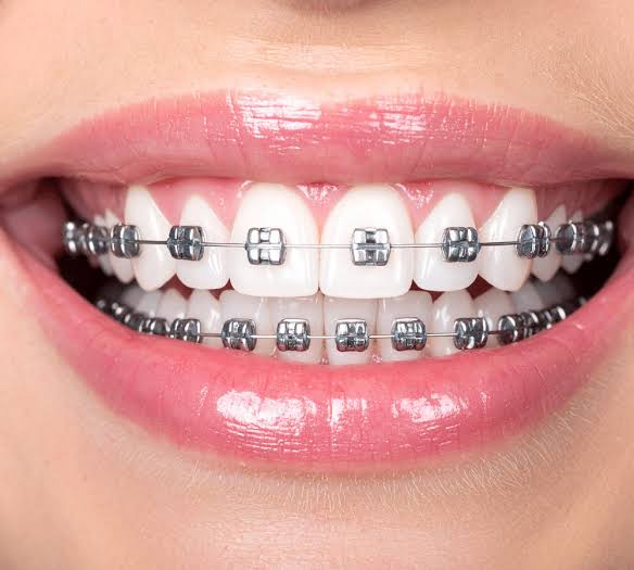 Orthodontic Braces Care at Niko Dental