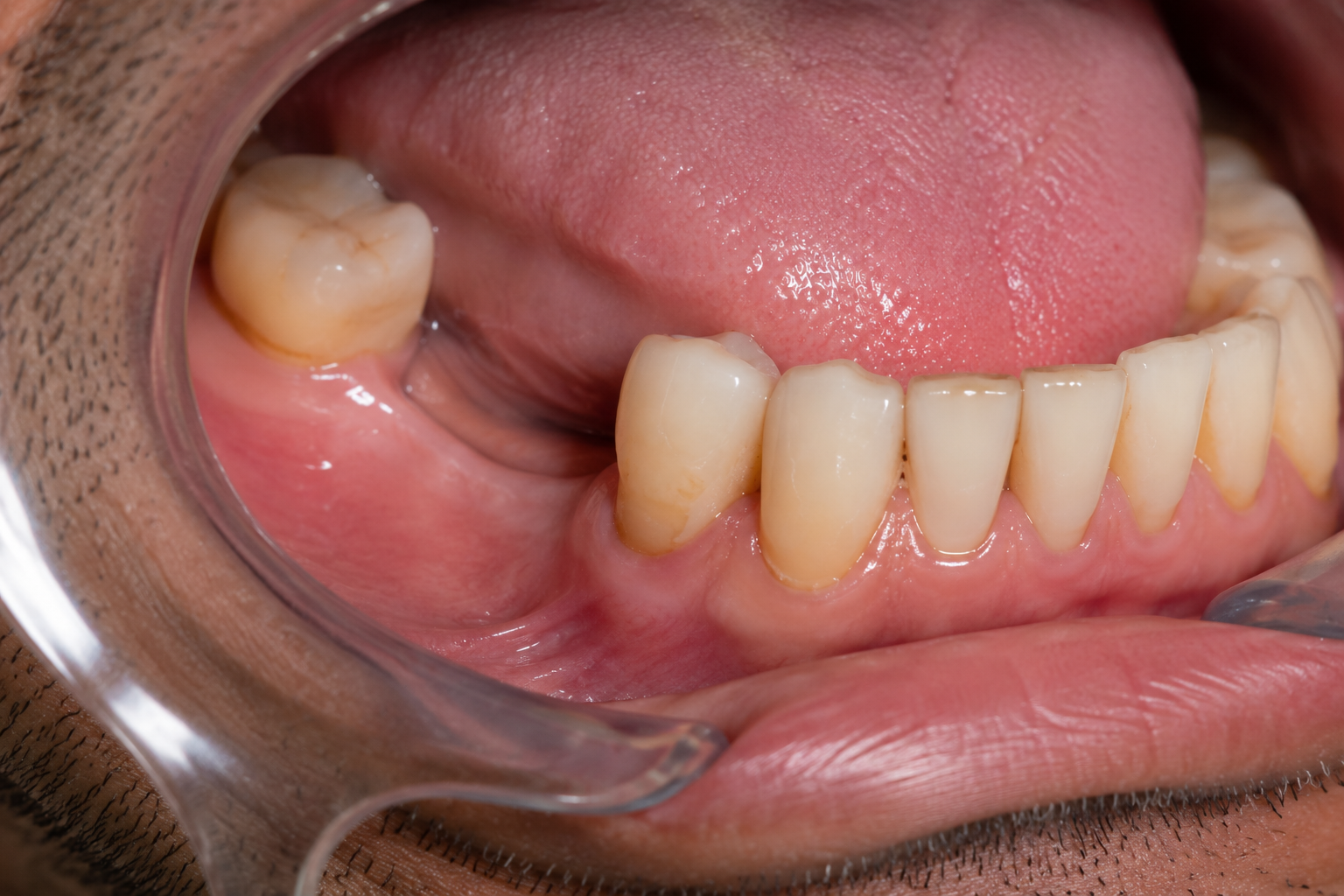 Step 1: Before Treatment