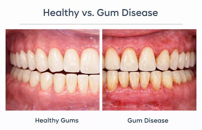 Healthy vs Unhealthy Gums at Niko Dental