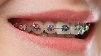 Traditional Metal Braces